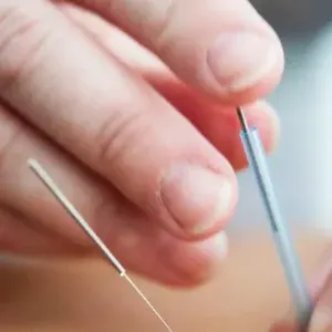 Acupuncture